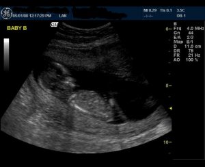 baby b 13 wks to post.JPG