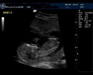 baby a 13 wks to post.JPG