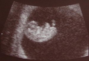 9w4d%20ultrasound.jpg