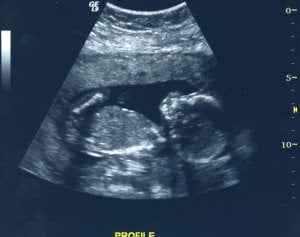 ultrasound18weeks.jpg