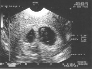 USTwins8-29(7.6wks).jpg