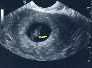 ultrasoundpic7weeks.jpg