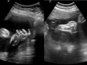 Baby fingers and thumb and baby foot 28w.JPG