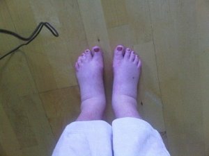 swollen feet and ankles poor thing.jpg