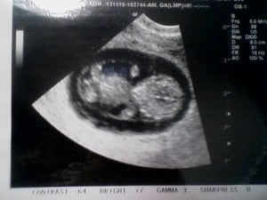 ultrasound 10 weeks.JPG