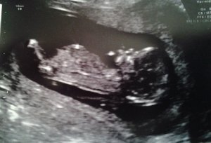 12wk-ultrasound.jpg