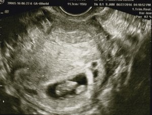 baby_2_first_scan_1.jpg