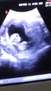 ultrasound006_zpsbfaf546f.png